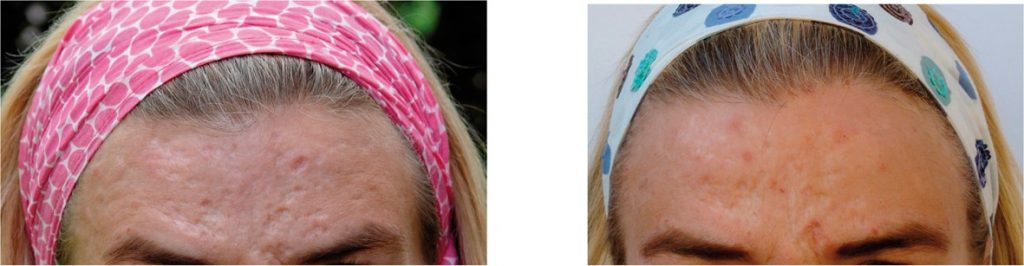 Dermaroller treatment for acne on the forehead